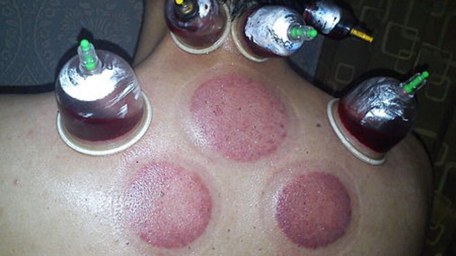 450px-Hijama_therapy