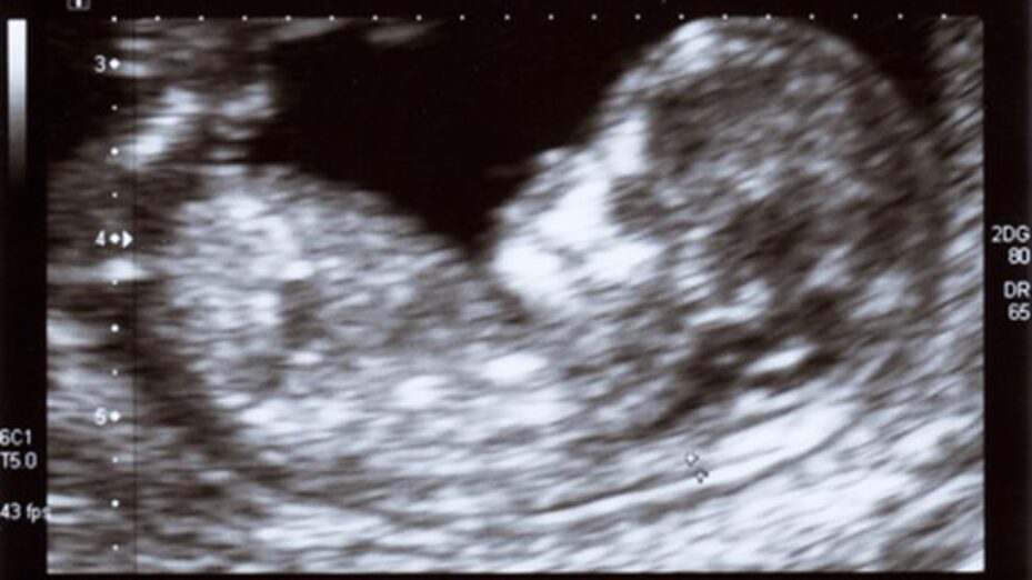 IVG foetus echographie
